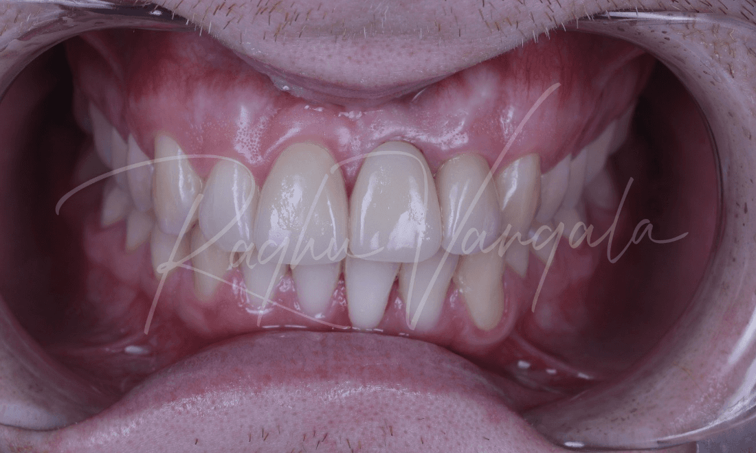 The teeth were restored for a symmetrical smile