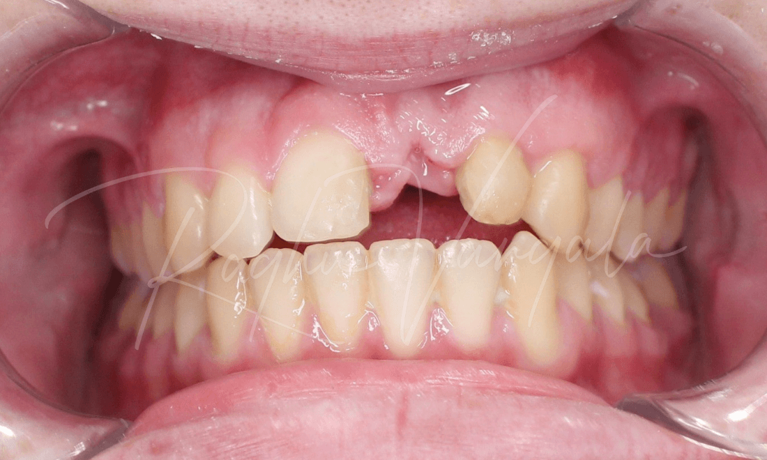Misssing upper front tooth and asymmetrical smile