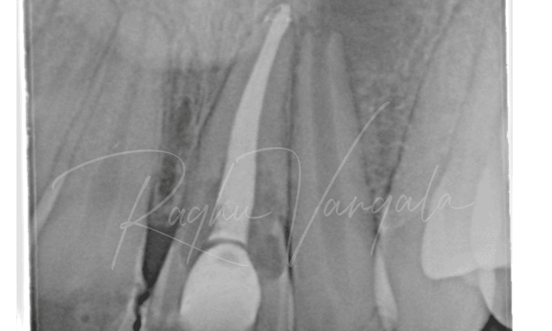 The x ary shows severely afftcted his front teeth