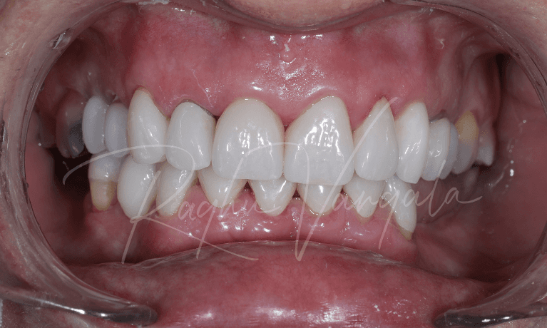 Crowns-Bridges-and-Implants-After-Image