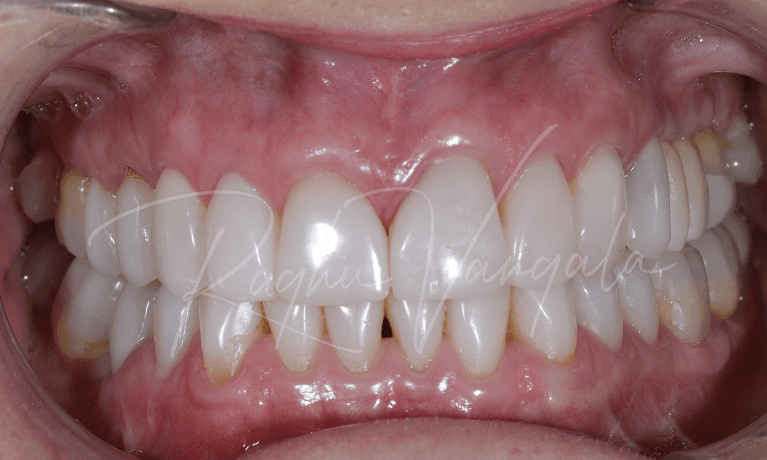Direct-Bonding-and-Implants-After-Image