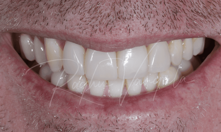 Front-Tooth-Implant-and-Veneers-After-Image