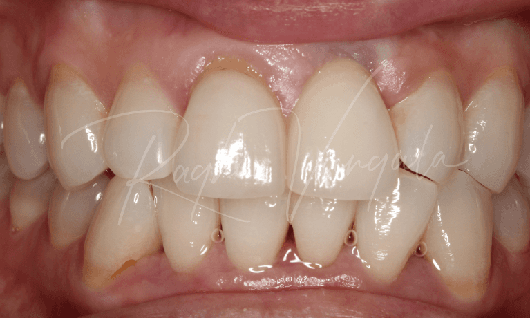 Front-Tooth-Implant-After-Image