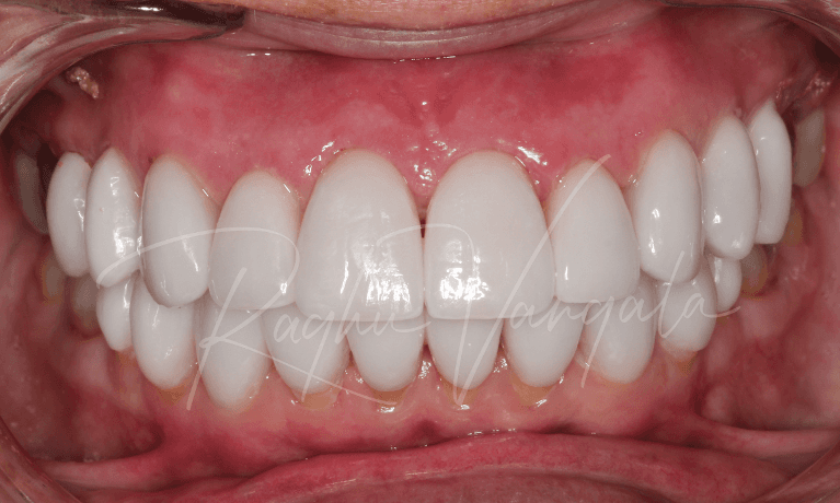 Indirect-Veneers-After-Image