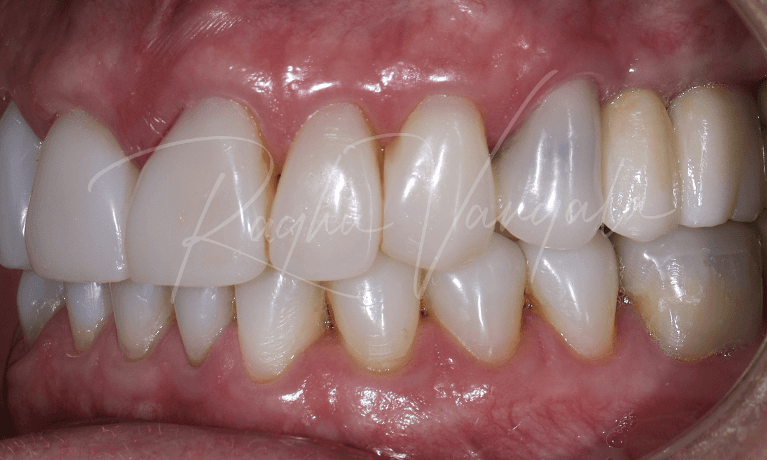 Implants-to-replace-missing-back-teeth-After-Image