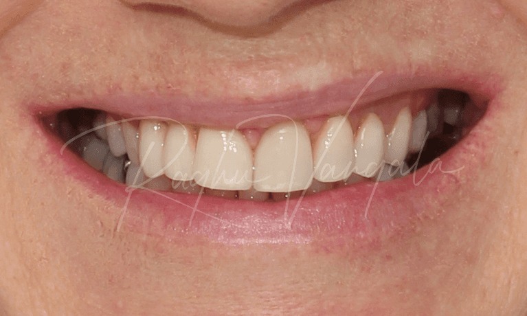 Smile-Makeover-After-Image