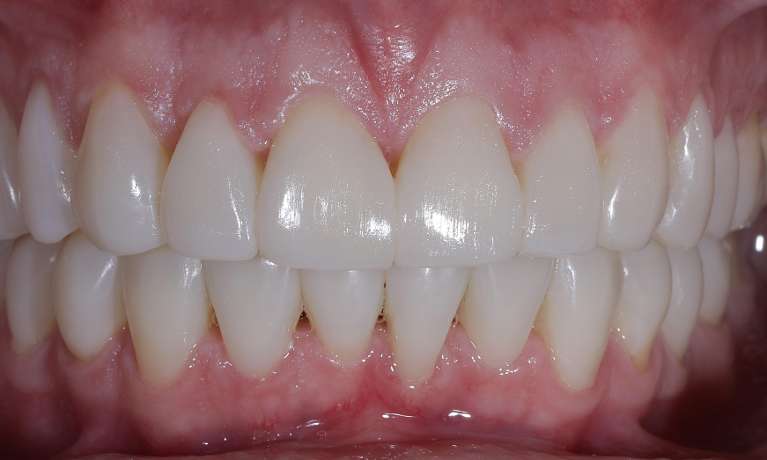 Smile-Make-over-After-Image