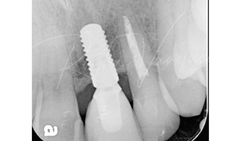 This x ray of 10 year follow up with implant crown, Root canal treatment wth crown and a veneer