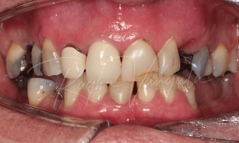 Crowns-Bridges-and-Implants-Before-Image