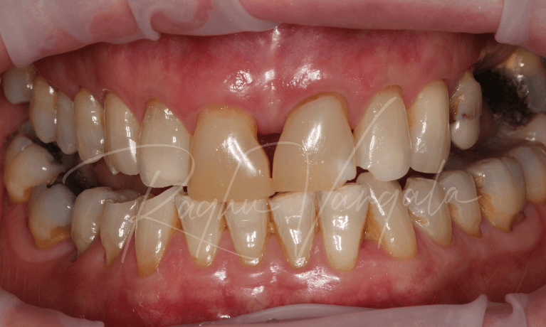 Direct-Bonding-and-Implants-Before-Image