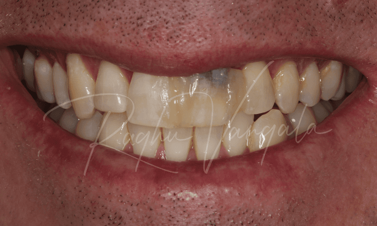 Front-Tooth-Implant-and-Veneers-Before-Image