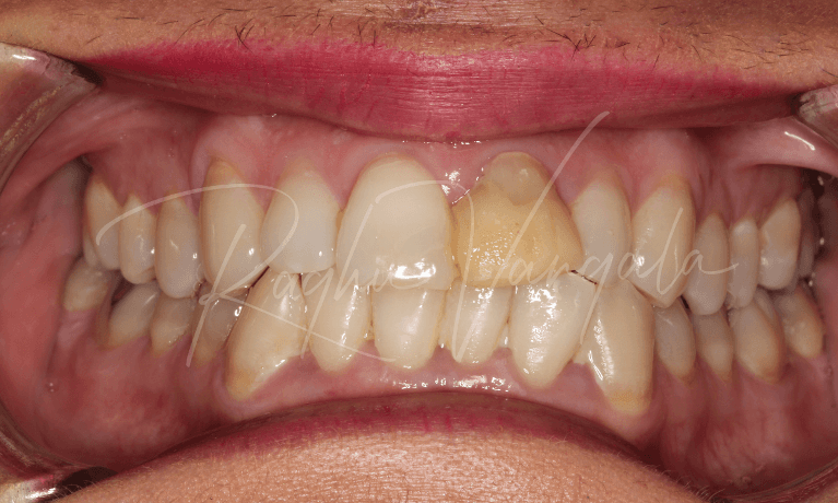 Front-Tooth-Implant-Before-Image