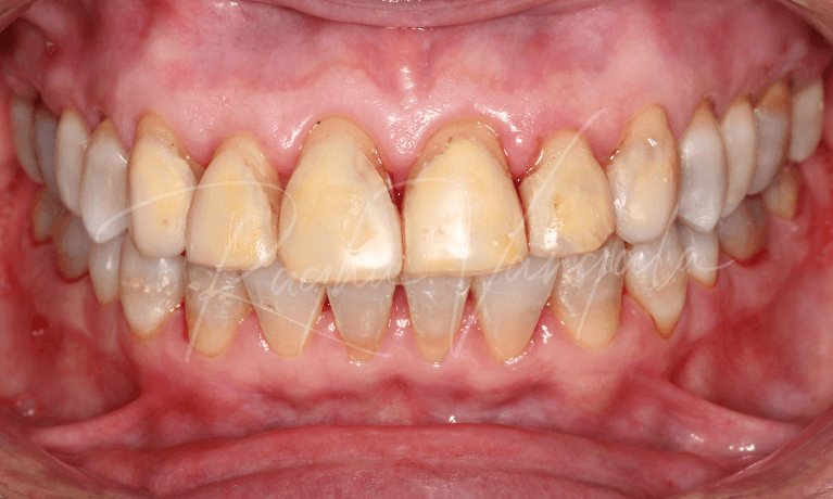 Indirect-Veneers-Before-Image