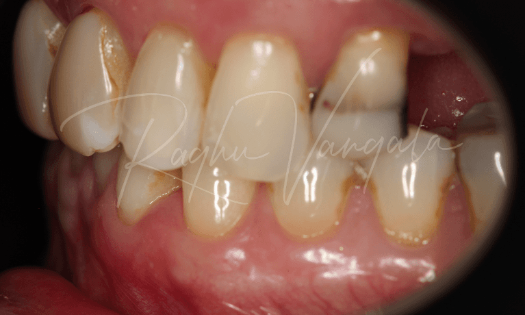 Implants-to-replace-missing-back-teeth-Before-Image