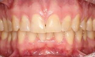 Smile-Make-over-Before-Image