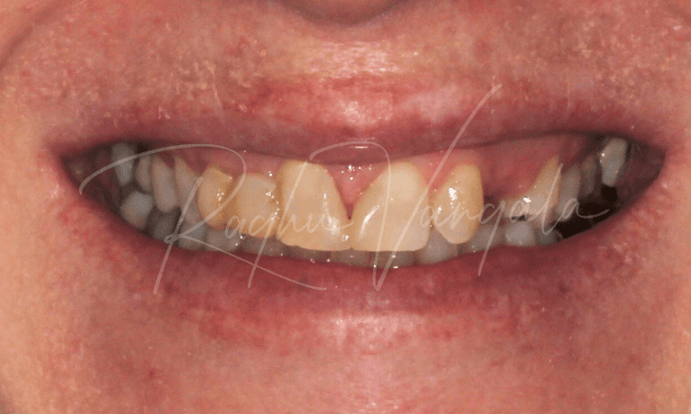 Smile-Makeover-Before-Image