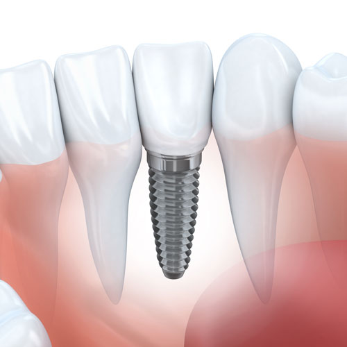 Tamworth Oral Health and Dental Care | Implants